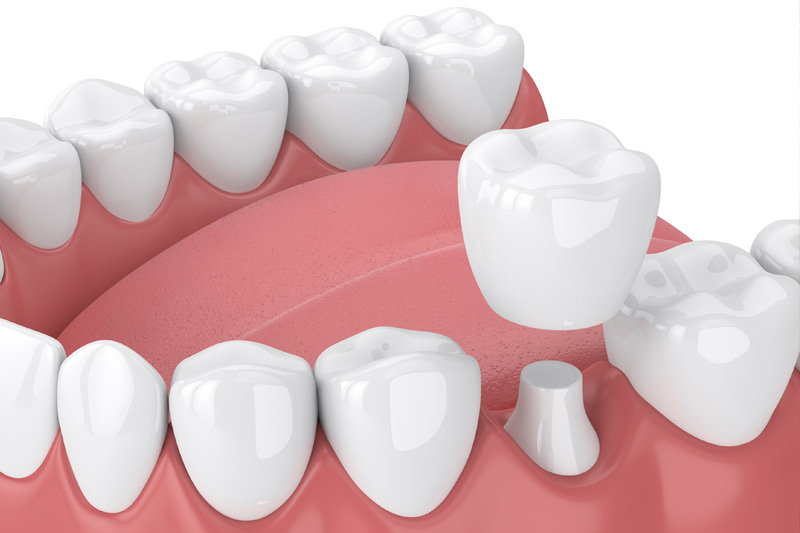 Dental Crowns in Brooksville