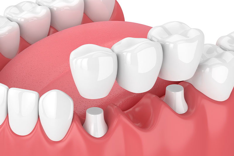 Dental Bridges in Brooksville