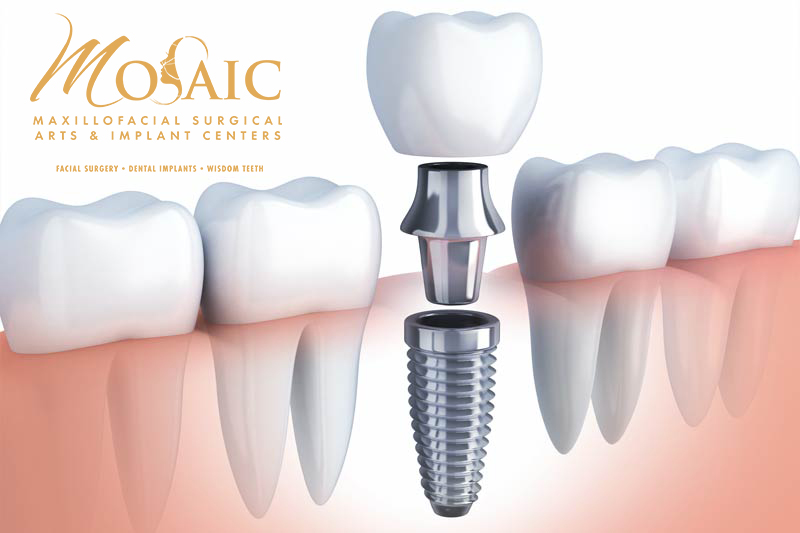 Dental Implants with MOSAIC in Brooksville
